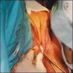 变性手术过程图示(男变女)