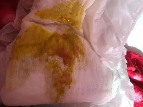 求助:4个月婴儿大便带血,有图 - 百度宝宝知道