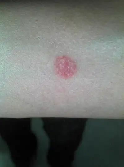 艾滋病红斑图片 (59)