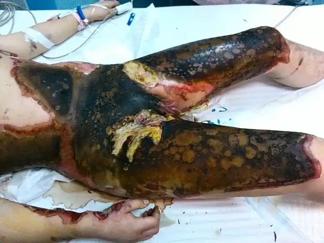 紧急求助各位烧伤专业大神们.