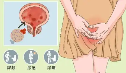 患者亲述:有尿就疼,2分钟就要尿,吃遍消炎止痛药不管用为哪般?