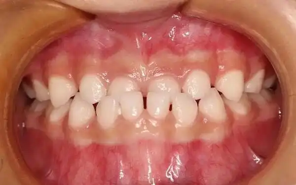 6个月大婴儿假性地包天图片是怎么样的?