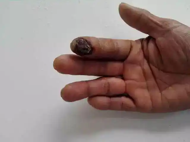 手指被高压水枪喷伤,一周后皮肤坏死,感染面临截指危险