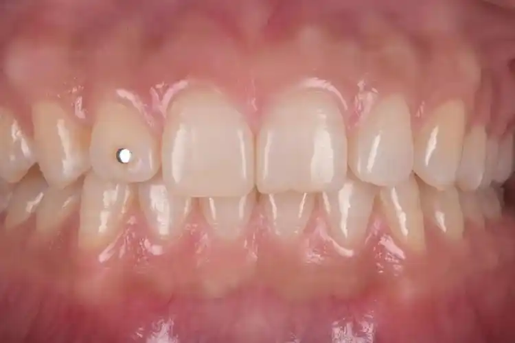 『口腔美学摄影』dsd设计照片组的拍摄与评估方法