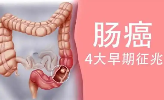 和直肠癌,由于与许多症状和造成腹痛的疾病相似,所以在早期很容易错诊