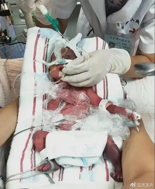 新生儿呼吸窘迫综合征