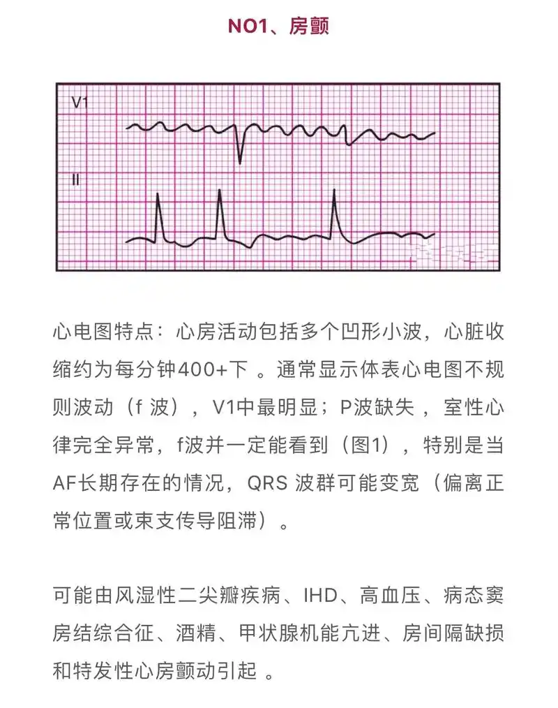 常见的几类心电图简要判读技巧.#手机里最近一张照片 #干货分 - 抖音