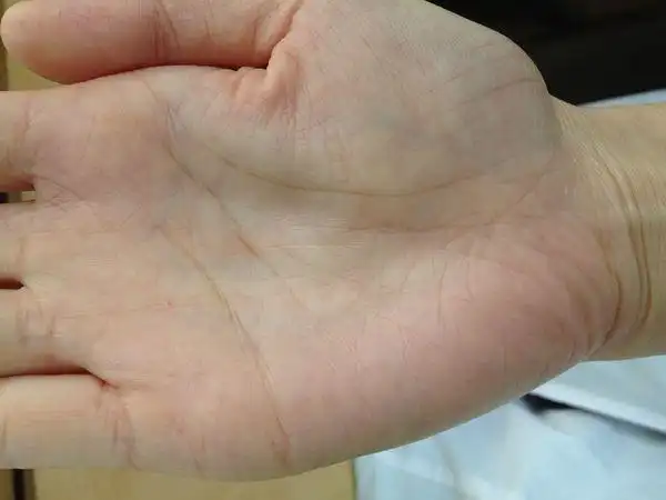 感情线上的岛纹如何可以消除?