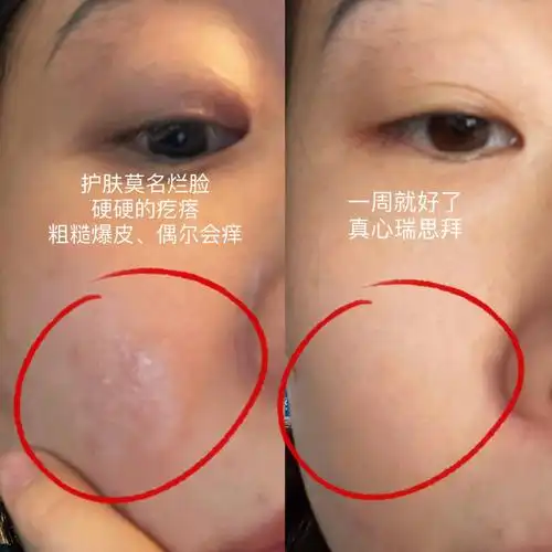 绝了屏障受损一定要用这个4天ko