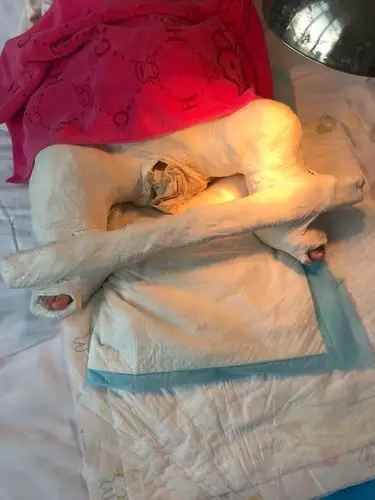 图58-2   双侧髋关节人字石膏固定