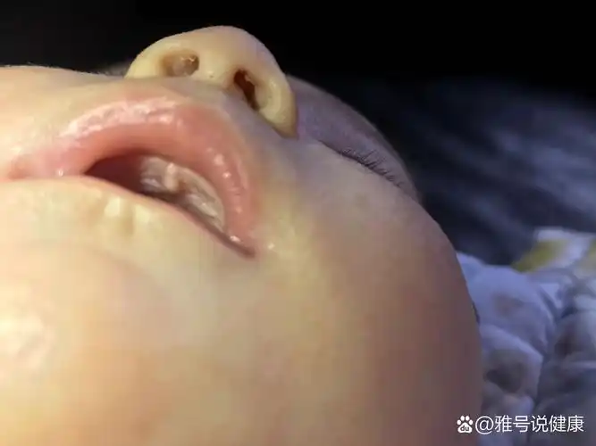 p>求助各位宝妈, 宝宝上颚白色的一块是什么?