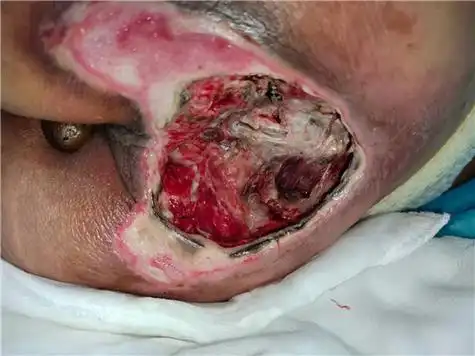 石家庄骶尾部褥疮孙某某_正定创必克医院