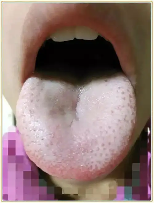 2,舌苔中间厚——伴有积食! 3,舌头上有小红点——体内有热,盖在