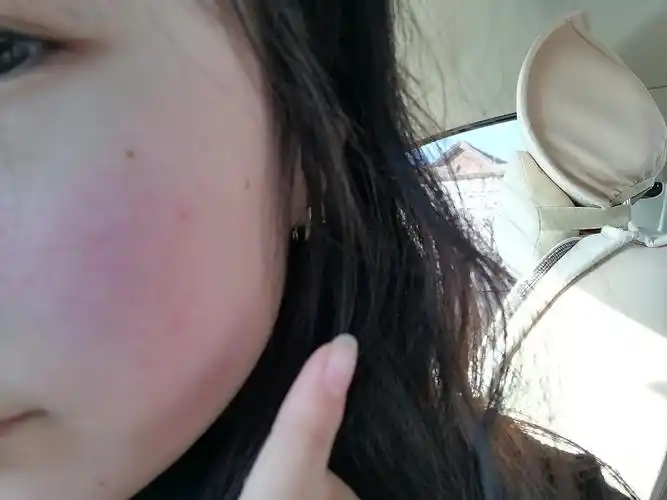 遇冷遇热皮肤泛红应该用什么修复😭