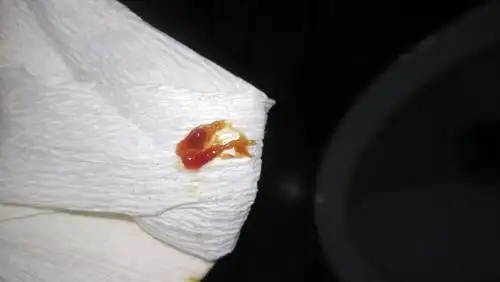 大便有这样红红的东西,跟吃了西瓜有关吗,前天大便