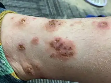 变应性皮肤血管炎小腿烂了表面结痂图