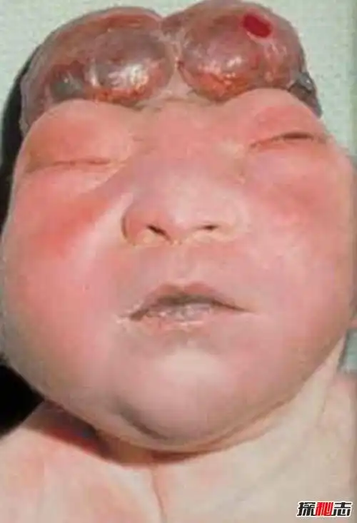 根据美国国家神经疾病和中风研究所的说法,"无脑婴儿通常是盲人,聋子