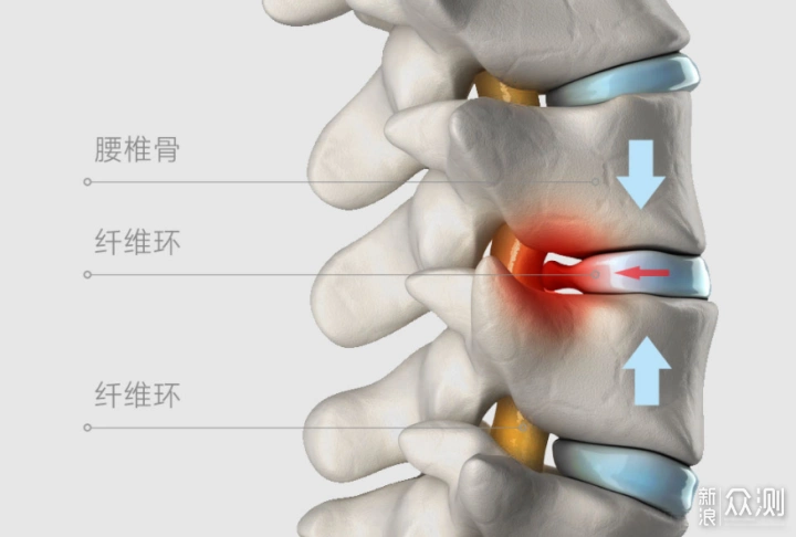 站起来腰痛难忍,这是因为长时间坐着腰椎骨压迫纤维环刺激腰椎神经
