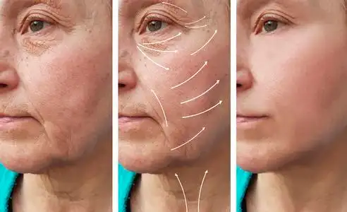 老年妇女面部皱纹矫正术前后箭头照片