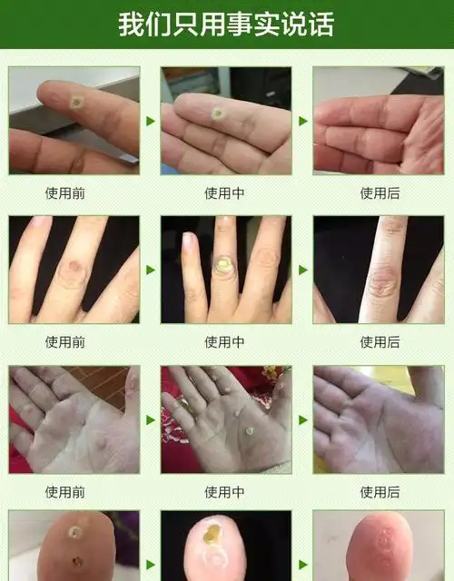 滴优鸡眼膏贴跖疣膏康肉刺脚底趾疣去除猴瘊子去根足部手药去疣灵