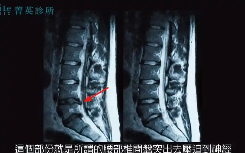 菁英诊所腰椎间盘突出非手术治疗新对策增生疗法prp干细胞