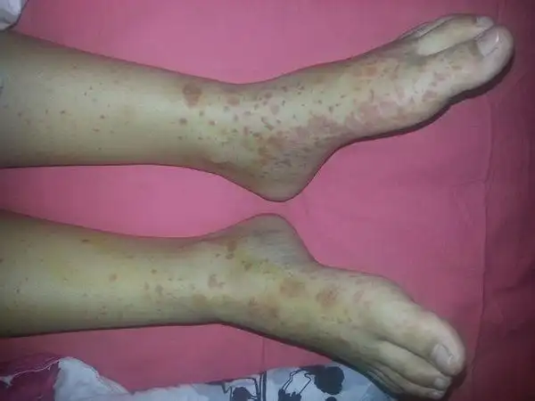 荨麻疹性血管炎症状