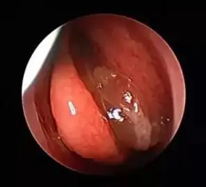 鼻息肉手术买什么保险 鼻息肉能买保险吗