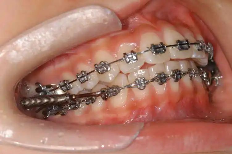 forsus矫治器(这是比较新的前导后缩下颌的治疗方法,请求加分)