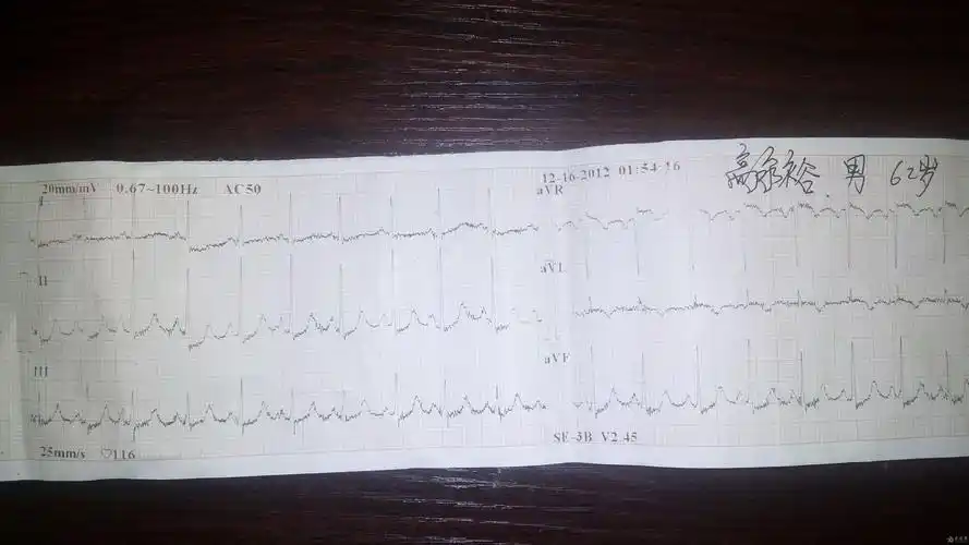 心电图t波高尖大家看看该是什么诊断