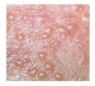 单纯疱疹病毒感染症