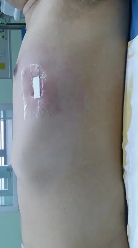 今天上午:重度桶状胸的"小手术"