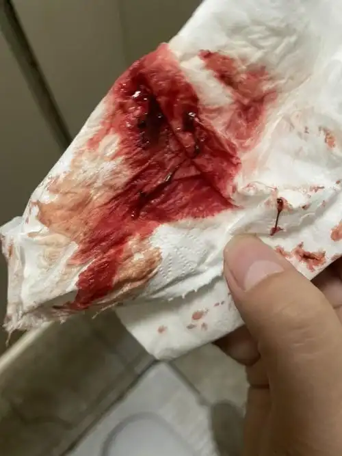 孕四周出血伴有腹痛,请大家帮忙看看