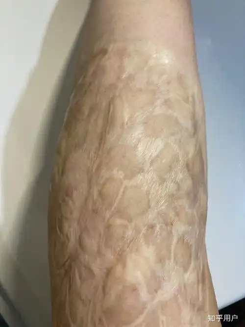 人们看到一个腿上有烫伤疤痕的女孩会怎么想呢?