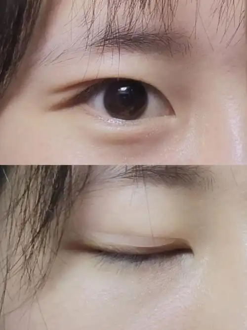 内双要怎么贴双眼皮贴