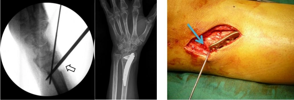 一文读懂克氏针:"最熟悉的陌生人"(转载) - 好大夫在线