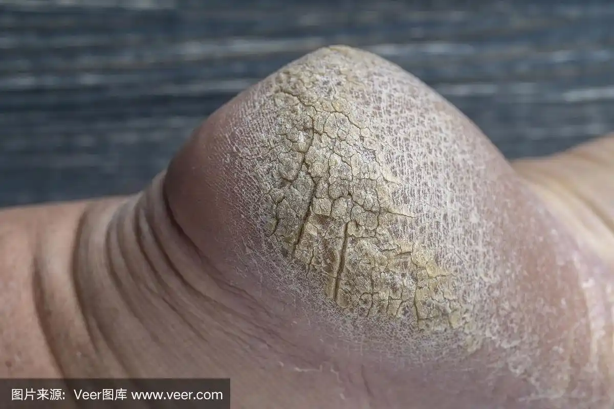 皲裂的人的脚后跟,裂纹脚跟图片特写.脚后跟皮肤干裂