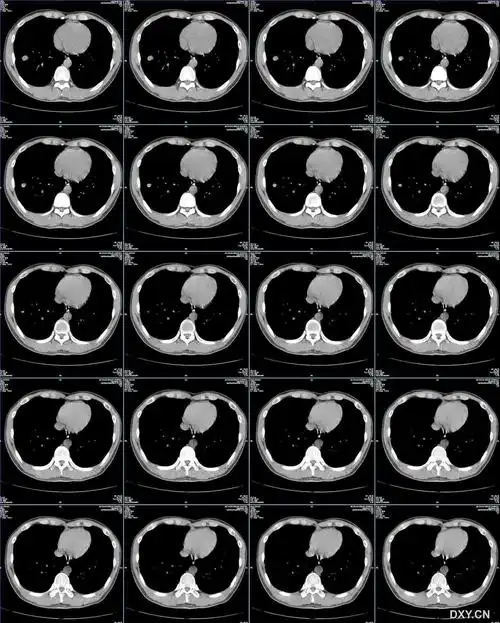 【讨论】30岁男性,体检发现右下肺结节影