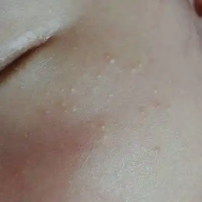 刚满月的宝宝,脸上起了很多这样的痘痘,脸颊,下巴,额头都有,是怎麼