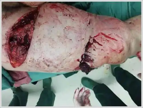 并向家属交代病情的严重性,最坏的打算就是截肢,现在需要做急诊手术