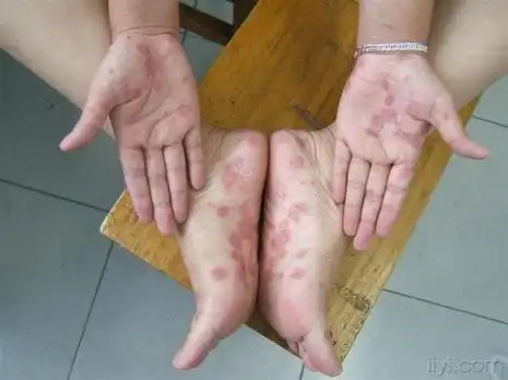 皮肤性病 帖子详情国医使者 中医科认证医师 考虑手足癣,排除梅毒