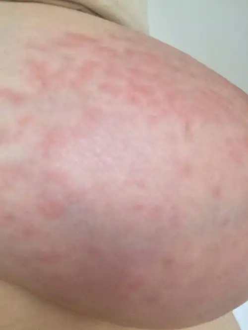 帮我看看乳房上长的什么?很痒!