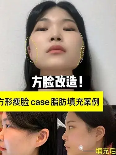 谈谈常见的三种方脸类型: 1方形圆脸 下脸稍宽,脸型比较偏圆,但颧骨