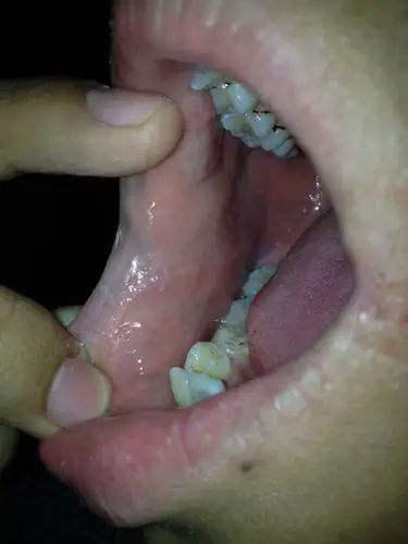 口腔里有这种白点(图) 沿上下嘴唇各有一条小白点组成的线 不疼不痒舌