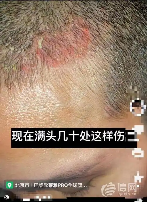 六漂三染后头皮被烧伤发型师离职欧莱雅旗舰店未作回应