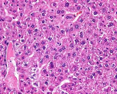 求指导肝病理切片,不知道如何描述