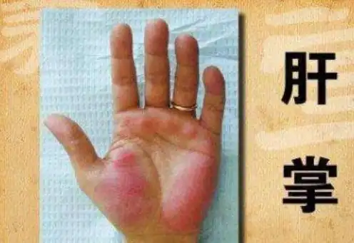 皮肤这一表现或是肝病前兆_四川健康网 天府健康网|四川第一健康门户