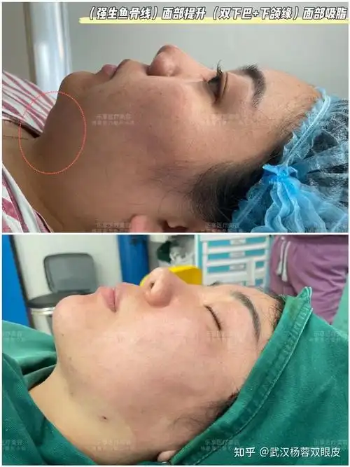 强生鱼骨线提升面部脂肪精雕双下巴下颌缘