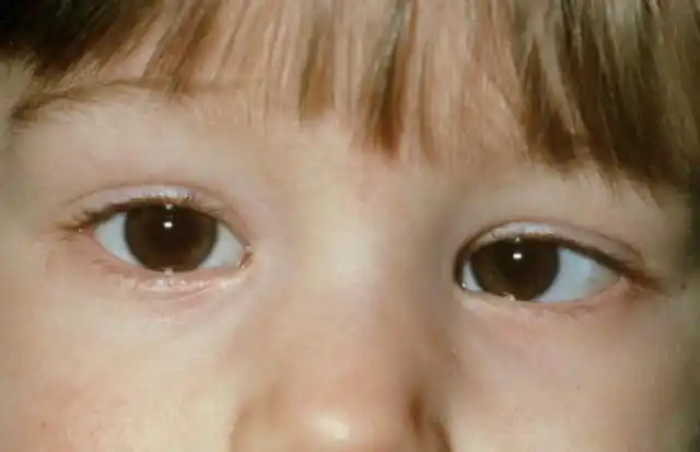 斜眼看:当遥远的目标不清楚时,孩子们通常喜欢斜视来弥补,因为当斜眼