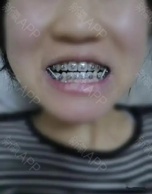 26岁,地包天掩饰性正畸八个月效果