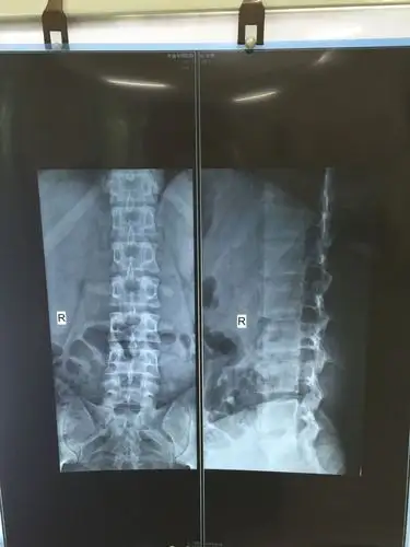 腰酸,拍片子是这样,医生说没有生理曲度,背部左右两边肌肉不对称,左边